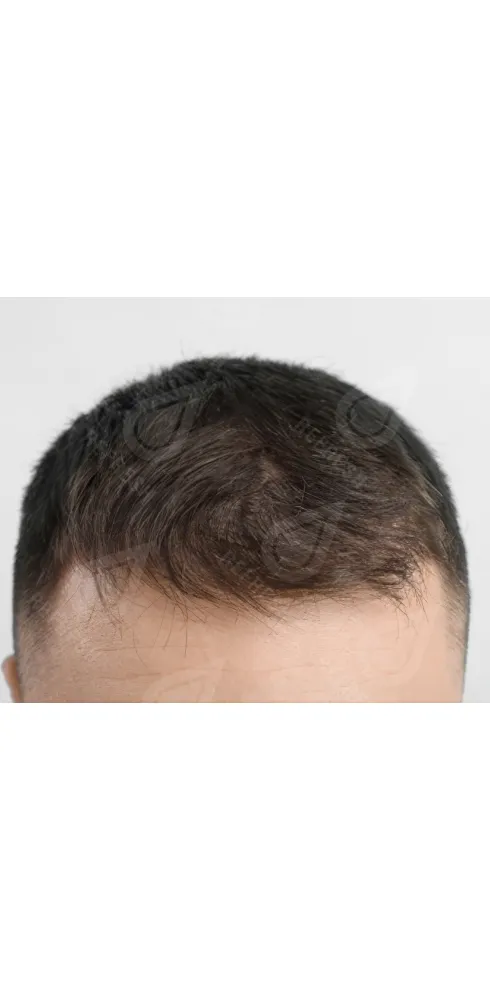 Рост волос 2