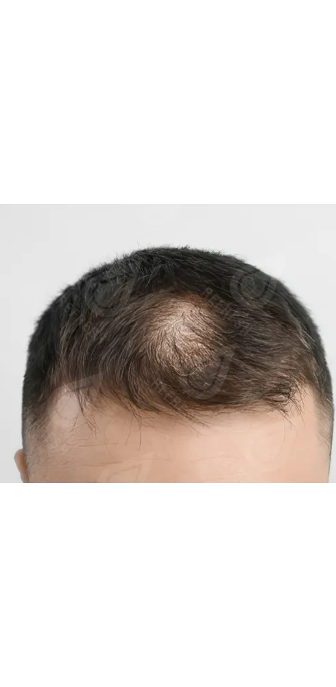 Рост волос 2